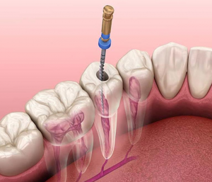 Endodontics Rotary Systems