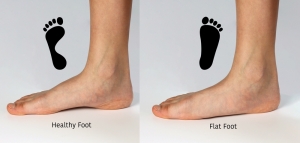 Flat Feet and Heel Pain are Common Foot Complaints that Occur Together!