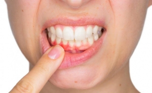 What Are The Advantages Of The Teeth Whitening Process?