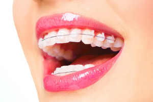How Much Does Invisalign Treatment Cost?