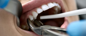 General Dentistry: The Importance of Dental Extractions for Oral Health!