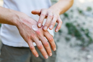How To Find Relief Through Targeted Psoriasis Treatment