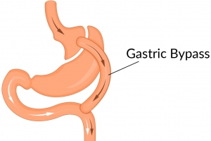 Gastric Bypass: An In-depth Analysis of How this Surgical Procedure Revolutionizes Weight Loss