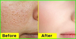 top Pore treatments