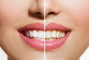 How Does Teeth Whitening Work: What to Expect