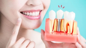 Everything You Need to Know About All on 4 Dental Implants