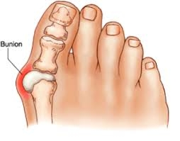 When Should I See a Podiatrist for My Bunions?