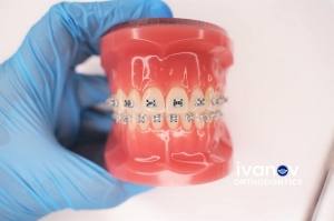 What To Know About Bottom Teeth Braces?