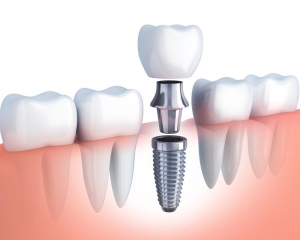 Signs You Need to Replace a Dental Implant Crown