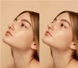 A Nose Reimagined: Stunning Non-Surgical Before and After Transformations