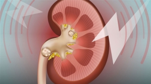 From Roots To Remedy: Ayurveda's Time-Tested Solutions for Kidney and Renal Stone Management