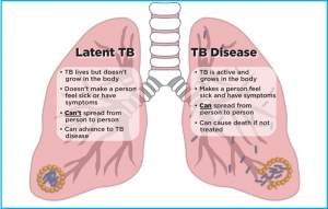 How Tuberculosis Affects The Lungs