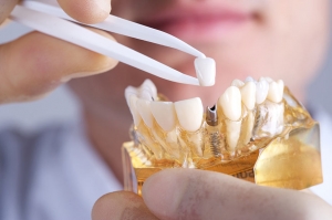 How to Avoid Potential Dental Implant Complications