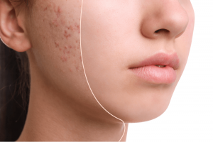 What is hormonal acne: its treatment & causes