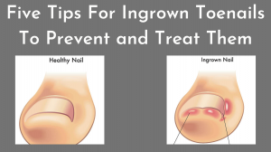 Five Tips For Ingrown Toenails To Prevent and Treat Them