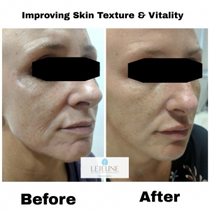 What is Profhilo Filler? How Profhilo Skin Treatment Enhances your Skin Tone?