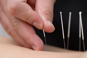 Acupuncture for Bursitis- Pros and Cons