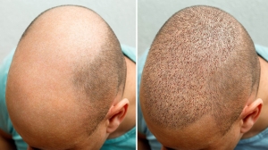 FUE Hair Transplant and Its Multiple Benefits