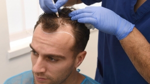 7 Best Things About Hair Transplant At Beverly Hills
