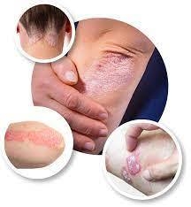 Psoriasis Research: Advances in Understanding the Condition